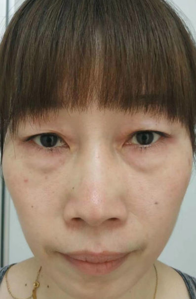 去眼袋手术