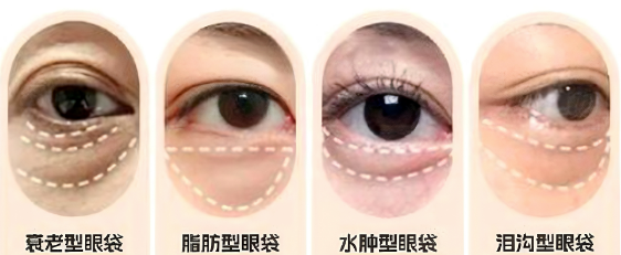 去眼袋手术