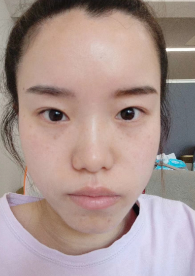 去眼袋手术