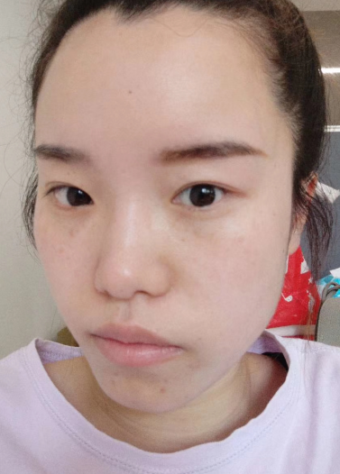 去眼袋手术