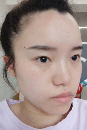 去眼袋手术