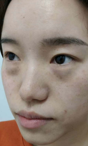 去眼袋手术