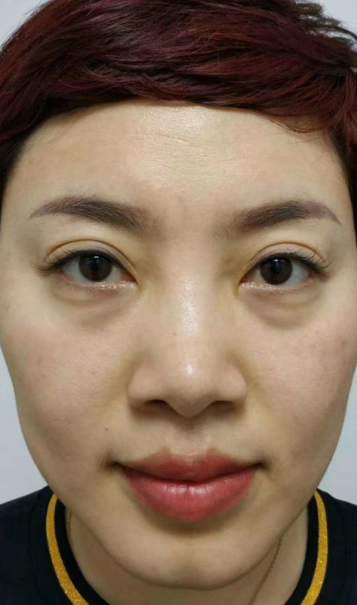去眼袋手术