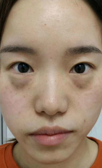 去眼袋手术
