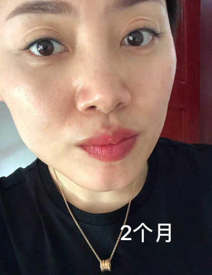 去眼袋手术