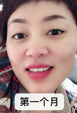 去眼袋手术