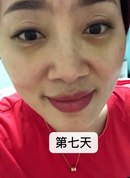 去眼袋手术