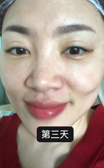 去眼袋手术