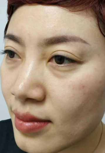 去眼袋手术