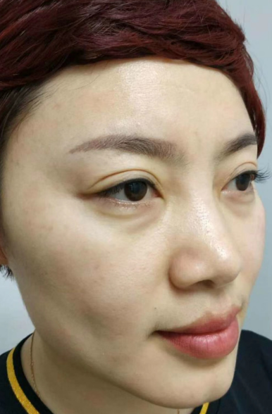 去眼袋手术
