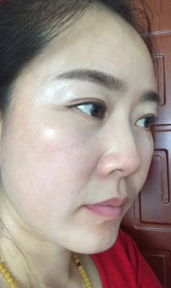 去眼袋手术