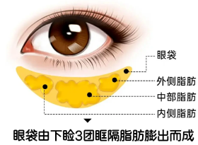 去眼袋手术