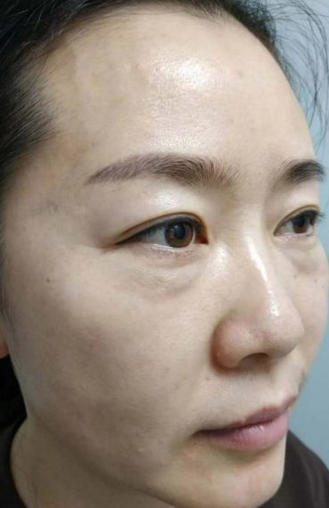 去眼袋手术
