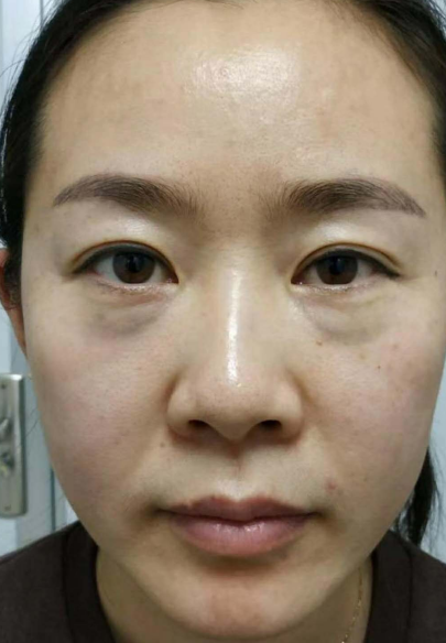 去眼袋手术