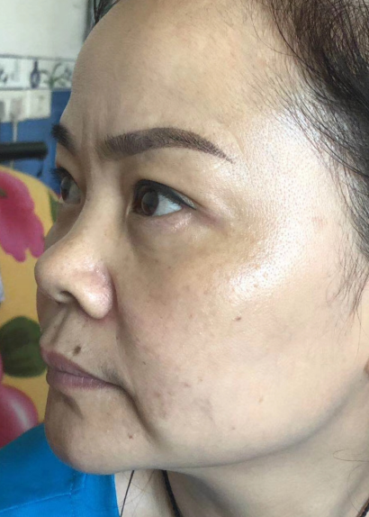 去眼袋手术