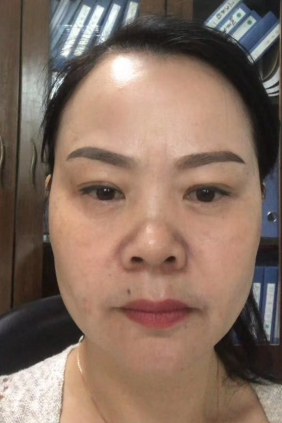 去眼袋手术