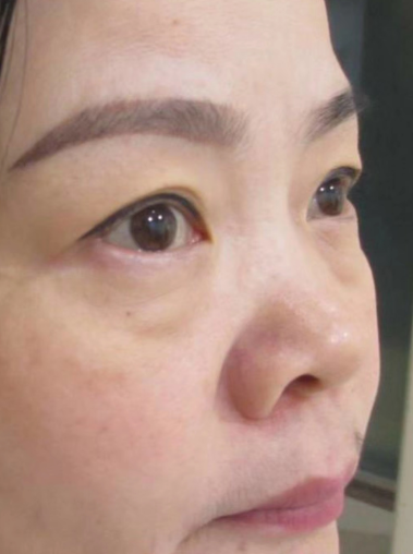 去眼袋手术