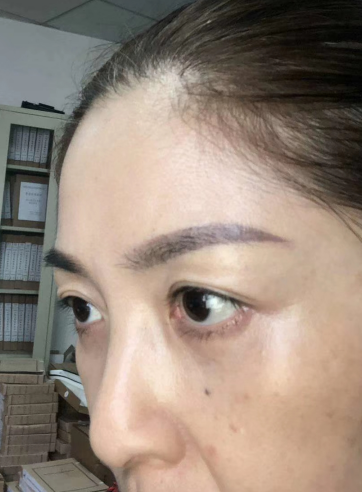 去眼袋手术