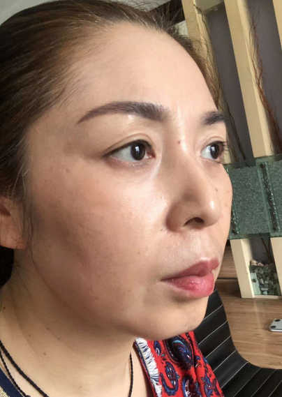 去眼袋手术