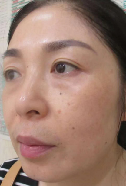 去眼袋手术