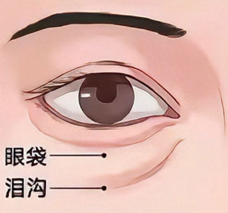 去眼袋手术