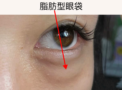 去眼袋手术