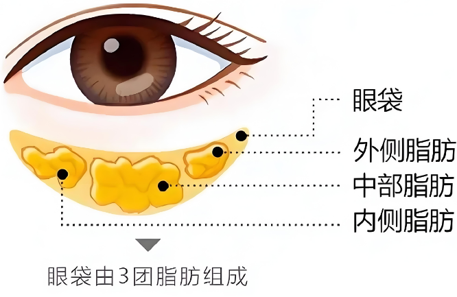 去眼袋手术