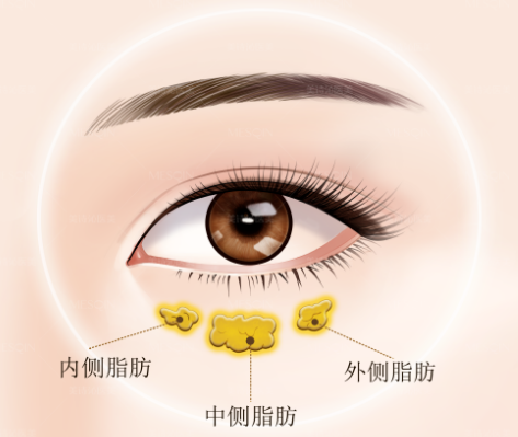去眼袋手术