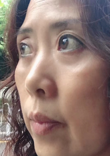 去眼袋手术