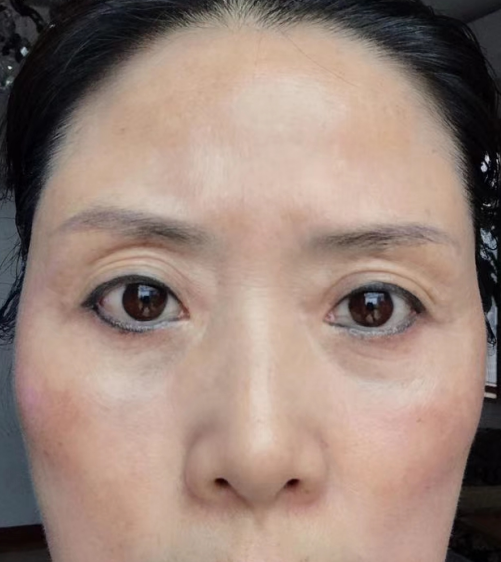 去眼袋手术
