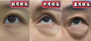 去眼袋手术