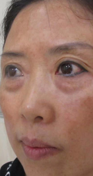 去眼袋手术