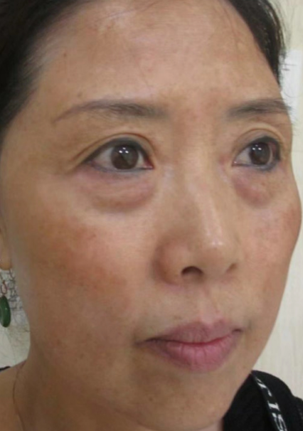 去眼袋手术
