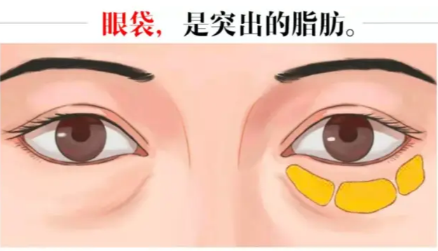 去眼袋手术