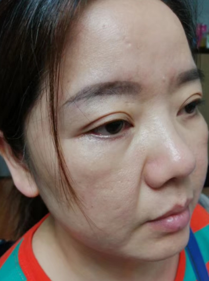 去眼袋手术