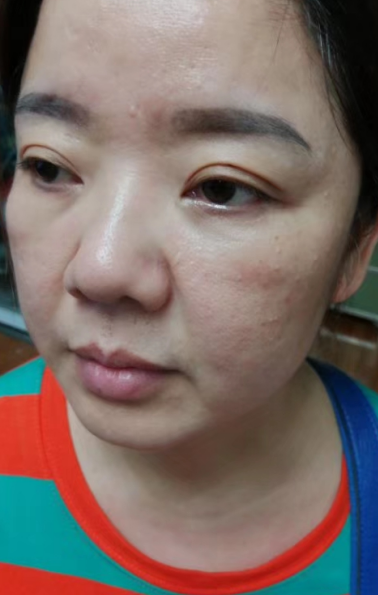 去眼袋手术