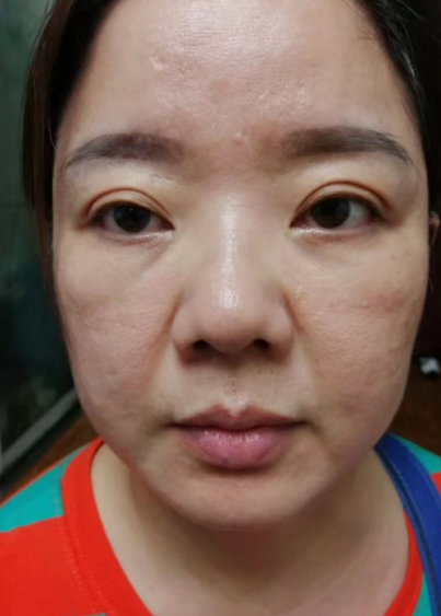 去眼袋手术