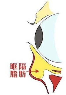 去眼袋手术