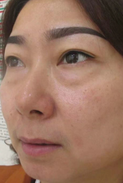 去眼袋手术