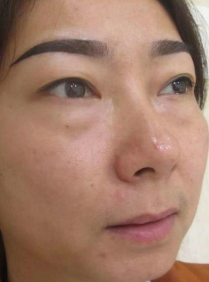 去眼袋手术