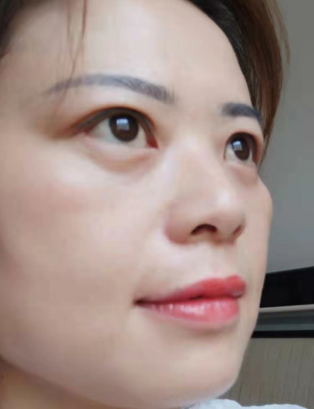 去眼袋手术