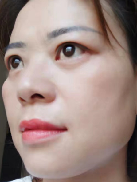 去眼袋手术
