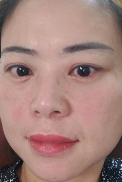 去眼袋手术