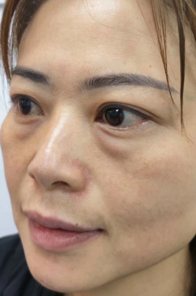 去眼袋手术