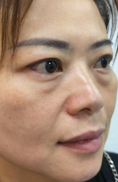 去眼袋手术