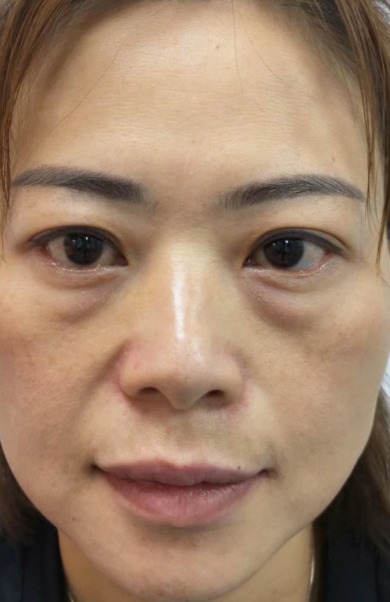 去眼袋手术