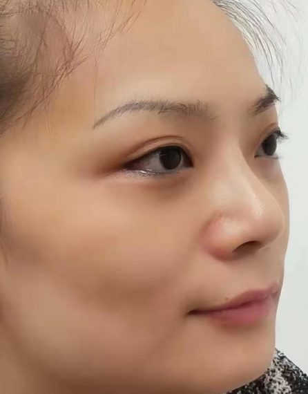 去眼袋手术