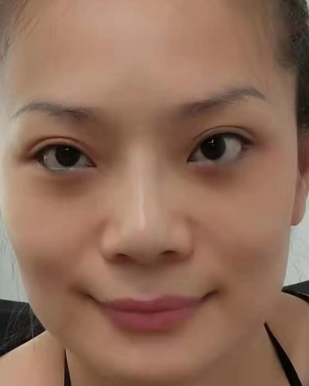 去眼袋手术