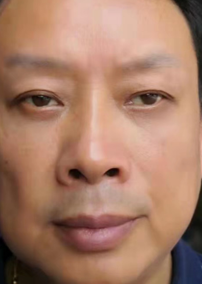 去眼袋手术