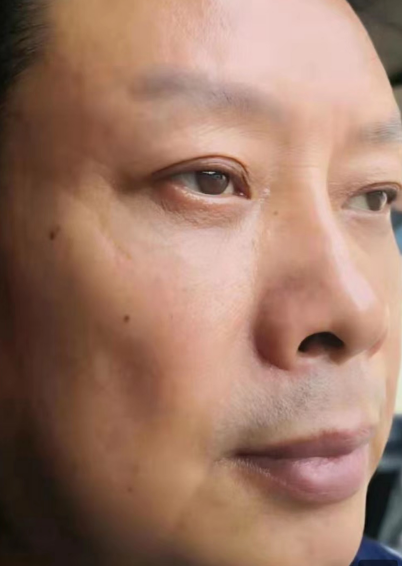 去眼袋手术
